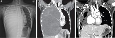 Case Report: Primary Thoracic Low-Grade Fibromyxoid Sarcoma in a Young Girl Presenting With Mediastinal Mass Syndrome